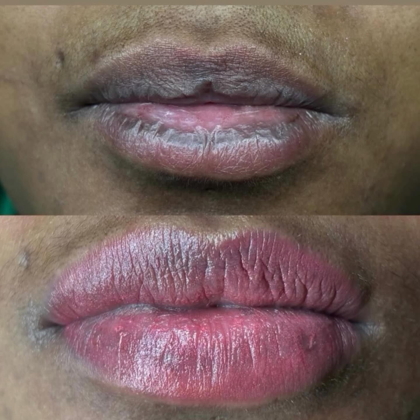 Lippen voor (boven) en na (onder)